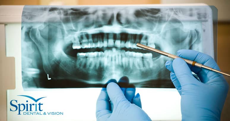 root canal vs extraction