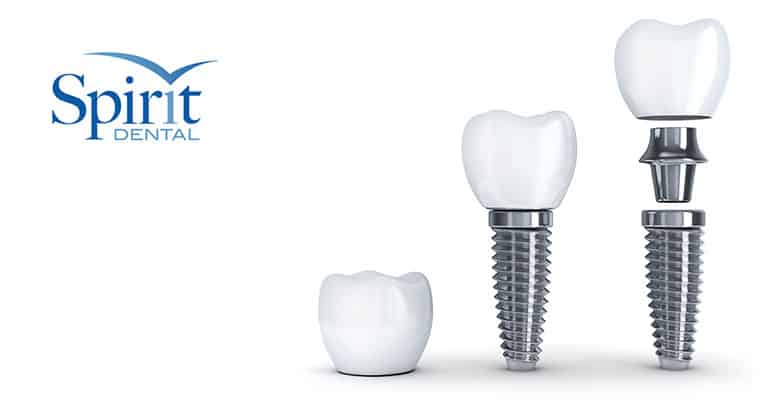 what are dental implants